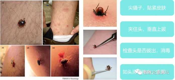 d7a4c6017f7cd9a3101b4b433e0c8ae466df90eb 如何安全拔掉蜱蟲
