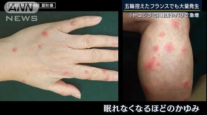 fb30254da75b11152d59d1c4fffcc88c8f08a476 床蝨吸人血
