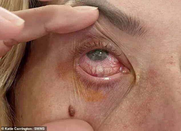 懒到两周不摘隐形眼镜,她一夜痛到失明!医生警告:这不是小事 懒到两周不摘隐形眼镜,她一夜痛到失明!医生警告:这不是小事